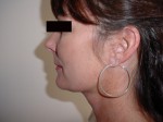 Liposuction of the Neck