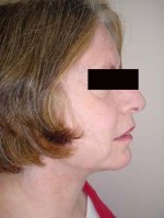 Liposuction of the Neck