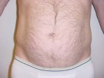 Liposuction of Waist