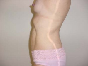 Liposuction of Abdomen