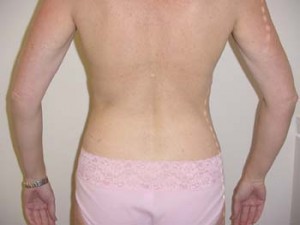 Liposuction of Abdomen