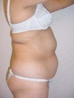 Liposuction of Abdomen