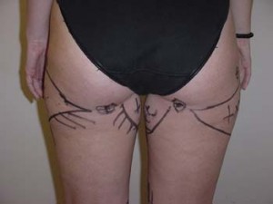 Liposuction of Thighs