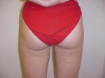 Liposuction of Thighs