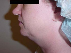 Liposuction of the Neck