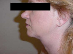 Liposuction of the Neck