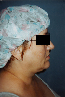 Liposuction of the Neck