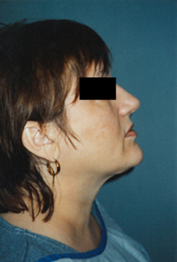 Liposuction of the Neck