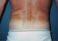 Liposuction of Waist