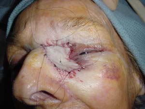 Skin Grafts