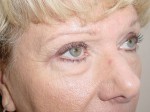 Blepharoplasty