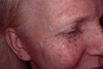 Laser Resurfacing