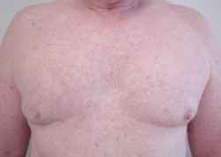 Chest Liposuction for Men