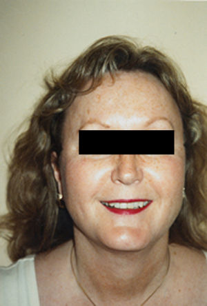 Liposuction of the Neck