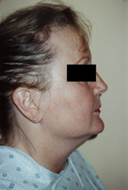 Liposuction of the Neck