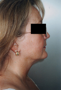 Liposuction of the Neck