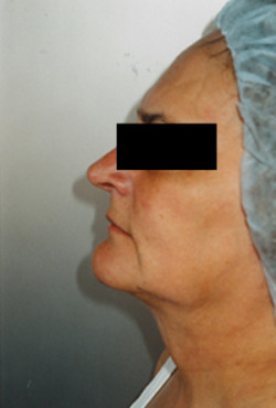 Liposuction of the Neck