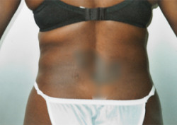 Liposuction of Waist