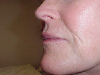 Lip Enhancement