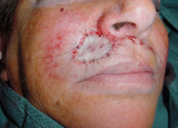 Reconstructive Surgery