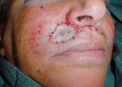 Reconstructive Surgery