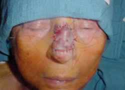 Reconstructive Surgery