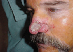 Reconstructive Surgery