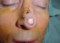 Reconstructive Surgery