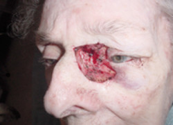 Reconstructive Surgery