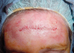 Reconstructive Surgery