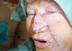 Reconstructive Surgery