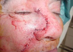 Reconstructive Surgery