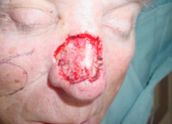 Reconstructive Surgery