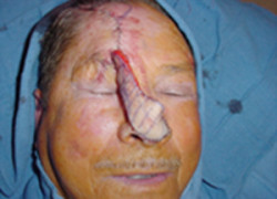 Reconstructive Surgery