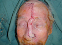 Reconstructive Surgery