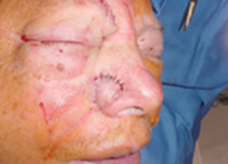 Reconstructive Surgery