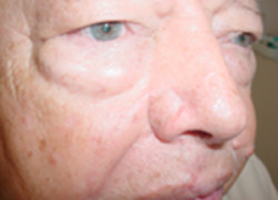 Reconstructive Surgery