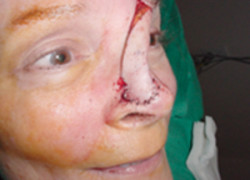 Reconstructive Surgery