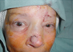 Reconstructive Surgery