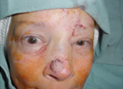 Reconstructive Surgery