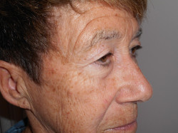 Blepharoplasty