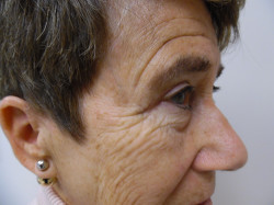 Blepharoplasty