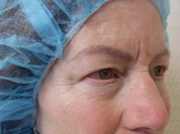 Blepharoplasty