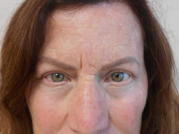 Blepharoplasty