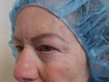 Blepharoplasty