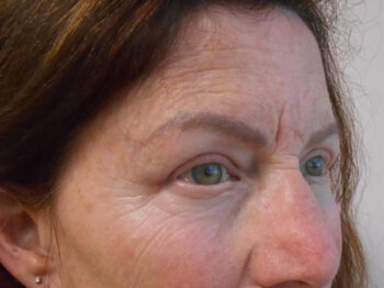 Blepharoplasty