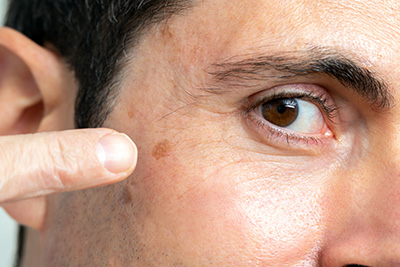 Detail of facial melanoma on middle aged man