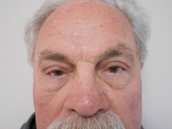 Blepharoplasty