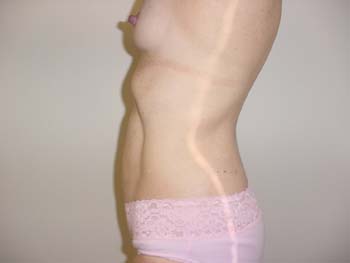 After Liposuction treatment by Dr. Ralph Massey in Los Angeles