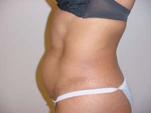 Before Liposuction Surgery